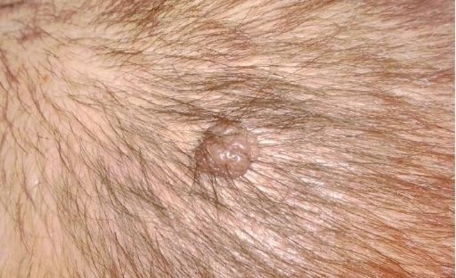 kak golove papilloma izbavitsya na izvinyayus Папиллома на голове как избавится фото