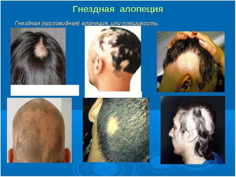 Как лечить гнездовую алопецию