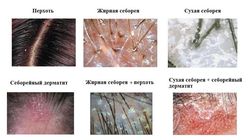 Как лечить псориаз в домашних условиях в голове Как лечить псориаз в домашних условиях в голове