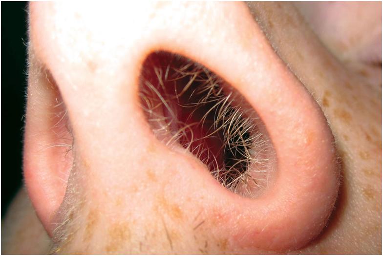 волосы в носу