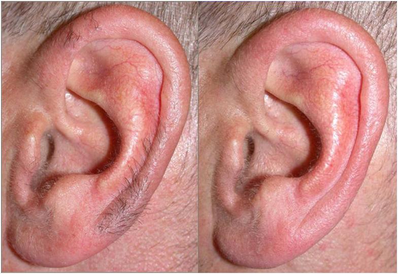 Фото ушных раковин до и после лазерной депиляции