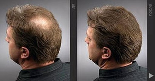 Лечение облысения