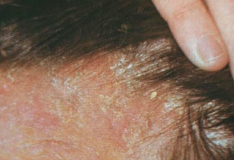 Себорейная экзема