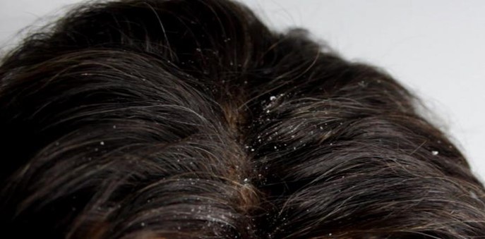 Виды перхоти