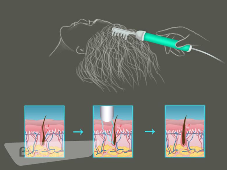 Дарсонваль от выпадения волос очень эффективен