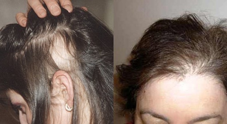 Сильно лезут волосы на голове у женщин. Экозависимая алопеция. Послеродовая телогеновая алопеция.