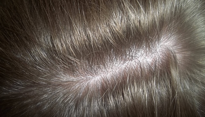 Перхоти нет