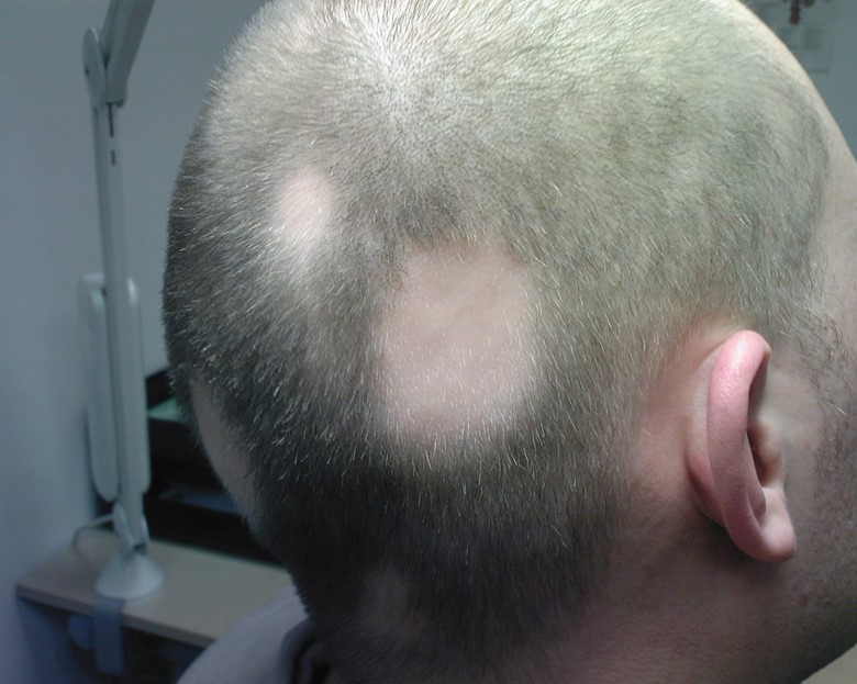 Аполеция Аполеция