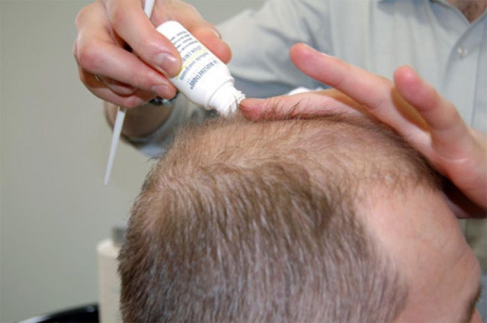 Лечение облысения