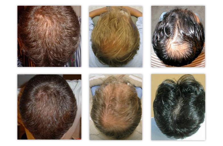 При мытье головы выпадает много волос. Выпадают волосы на макушке. Восстановила волосы после облысения. Рост волос на голове.