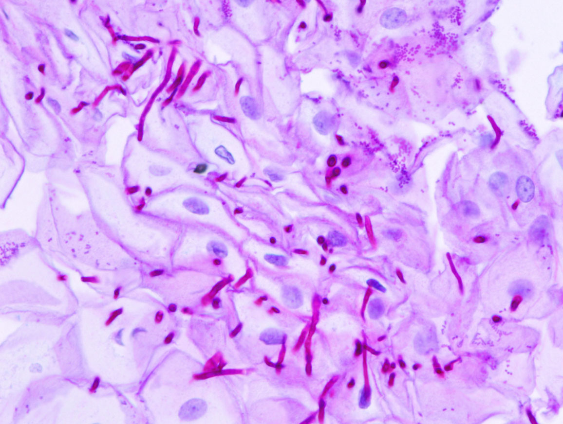 Грибок Malassezia