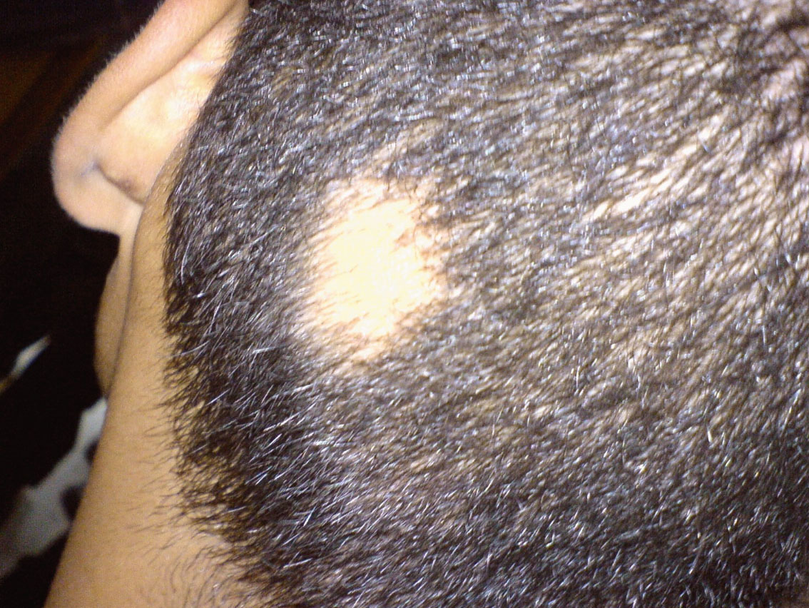 Рубцовая алопеция