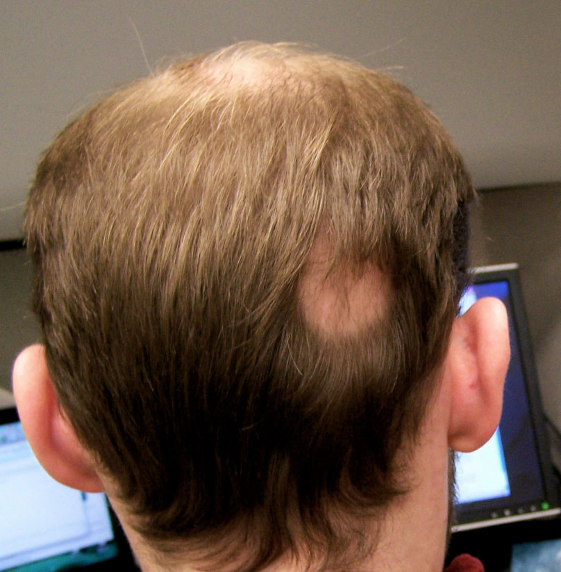 Травматическая алопеция