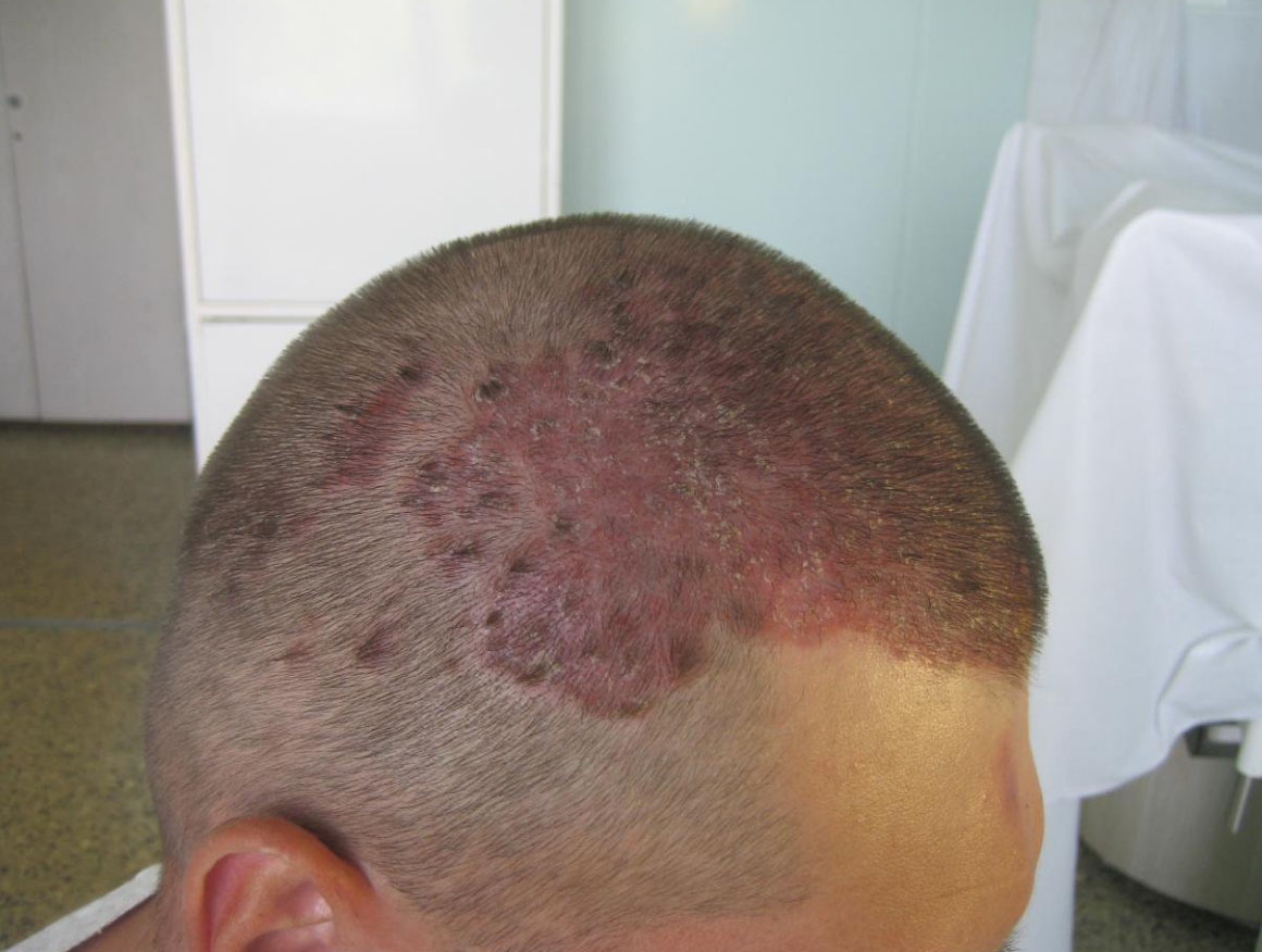 дерматомикоз на голове