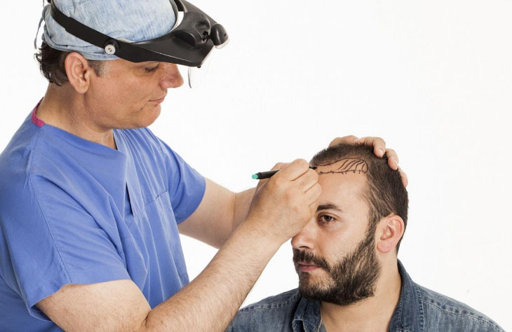 Пересадка волос без операции